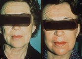 Green peel to face