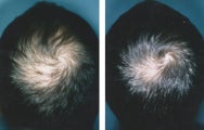 Medical treatment for hair loss (no surgery)`