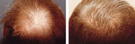 Medical treatment for hair loss (no surgery)