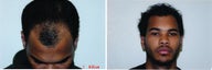 DIFF ANGLES -  Hair Transplant 