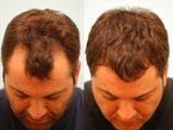Hair Transplant