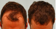 Hair Transplant