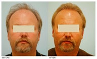 Hair Transplant