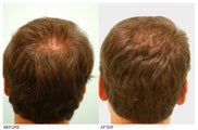 Crown (Vertex) Hair Transplant