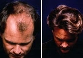 Hair Transplant