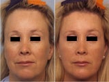 Hairline lowering
