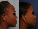 Hairline lowering