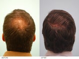Hair Transplant 
