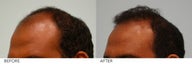 Hair Transplant 