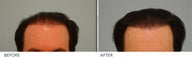 Hair Transplant 