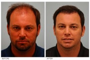 Hair Transplant 