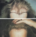female hair transplant