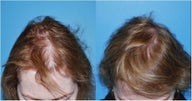 Hair Transplant