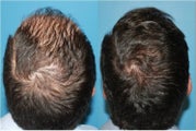 Hair Transplant