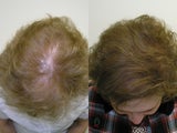 Hair Transplantation
