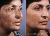 Hyperpigmentation Correction