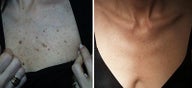 Upper chest freckles and spots removed by laser