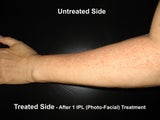 Intense Pulsed Light (IPL / Photo Facial) of half of Arm
