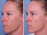 IPL for Brown Spots