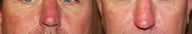 Intense Pulse Light (Photo Rejuvenation)