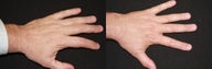 Photorejuvenation