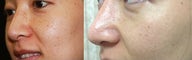 Full Face IPL Treatment