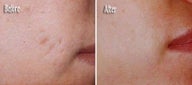 IPL for Acne Scar Treatment