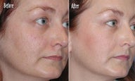 IPL for Age Spots, Hyperpigmentation