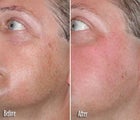  IPL for Age Spots and Freckles