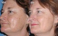  IPL for Age Spots
