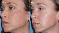  IPL for Age Spots and Freckles