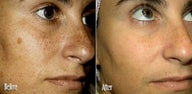  IPL for Age Spots and Freckles