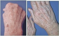  IPL Before and After for Age spots