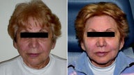 Panfacial Filler