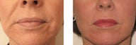 Liquid Facelift