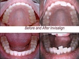 Invisalign