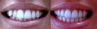 Invisalign