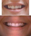 Invisalign