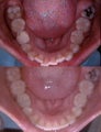 Invisalign