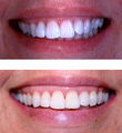 Invisalign