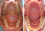 Invisalign