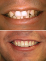 Invisalign