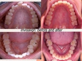 Invisalign