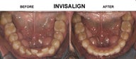 INVISALIGN before and after
