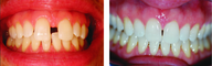 Invisalign