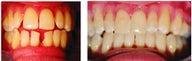 Invisalign