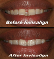 Invisalign