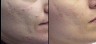 Aesthera Isolaze for acne