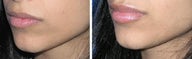 Lip Augmentation