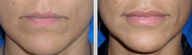Lip Augmentation